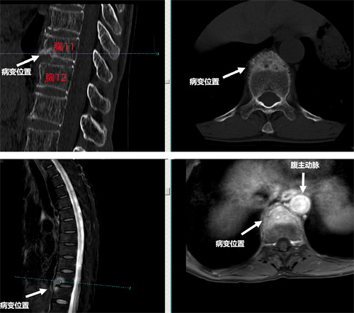 术前椎体CT及增强MRI检查提示胸11,12椎体骨破坏.jpg