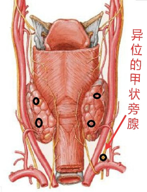 甲状旁腺解剖位置图片