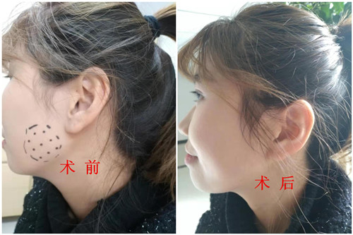术前术后对照_副本.jpg