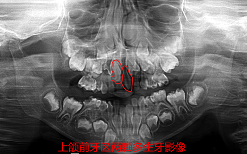 小悦悦口腔全景片_副本.png