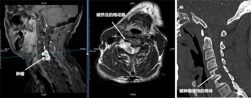 术前影像可见肿瘤侵蚀多个椎体，压迫脊髓及椎动脉.png