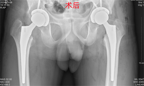 术后_副本_副本.jpg